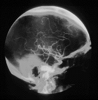 Angiogram of human head